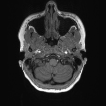 Cerebral cavernous venous malformation (Radiopaedia 70008-80021 Axial T1 6).jpg