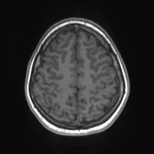 Cerebral cavernous venous malformation (Radiopaedia 70008-80021 Axial T1 68).jpg