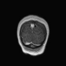 File:Cerebral cavernous venous malformation (Radiopaedia 70008-80021 Coronal T1 C+ 6).jpg