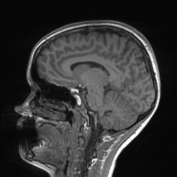 File:Cerebral cavernous venous malformation (Radiopaedia 70008-80021 Sagittal T1 33).jpg