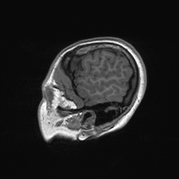 File:Cerebral cavernous venous malformation (Radiopaedia 70008-80021 Sagittal T1 9).jpg
