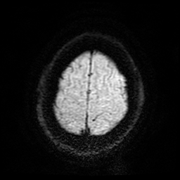 Cerebral cavernous venous malformation (Zabramski type II) (Radiopaedia 85511-101198 Axial DWI 27).jpg