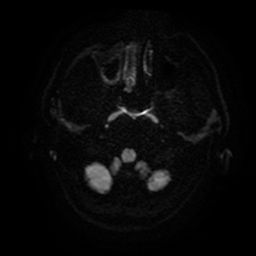 Cerebral cavernous venous malformation (Zabramski type II) (Radiopaedia 85511-101198 Axial DWI 37).jpg