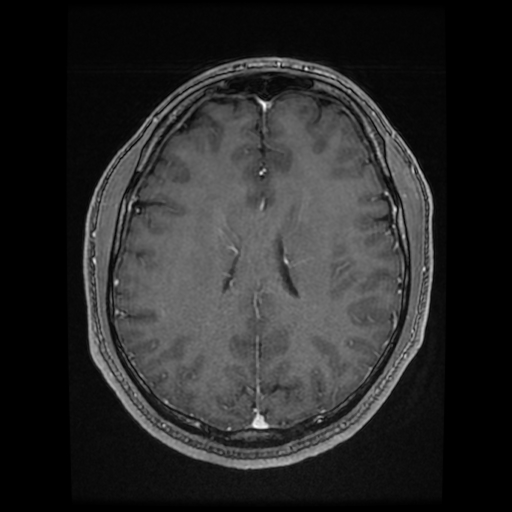 Cerebral cavernous venous malformation (Zabramski type II) (Radiopaedia 85511-101198 Axial T1 C+ fat sat 35).jpg