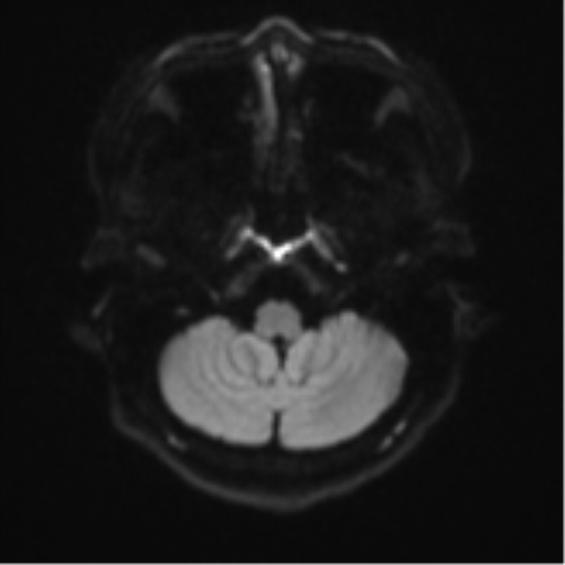 Cerebral cavernous venous malformations (Radiopaedia 48117-52946 Axial DWI 32).png