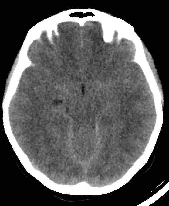 Cerebral edema due to severe hyponatremia (Radiopaedia 89826-106937 Axial non-contrast 37).jpg