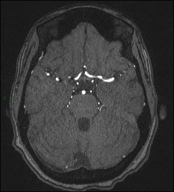 Cerebral fat embolism (Radiopaedia 35022-36525 Axial TOF 68).jpg