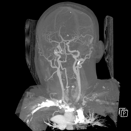 File:Cerebral hemorrhage secondary to arteriovenous malformation (Radiopaedia 33497-34571 A 4).png