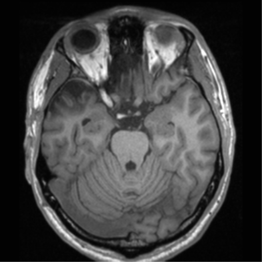 File:Cerebral hemorrhagic contusions- temporal evolution (Radiopaedia 40224-42757 Axial T1 27).png