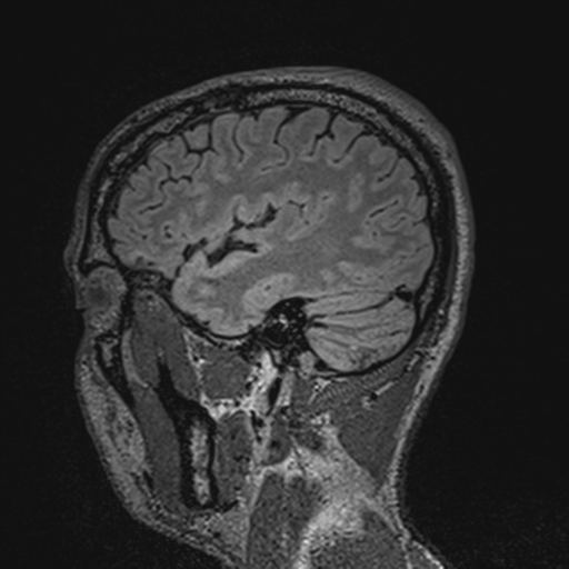 File:Cerebral hemorrhagic contusions- temporal evolution (Radiopaedia 40224-42757 Sagittal T1 20).png