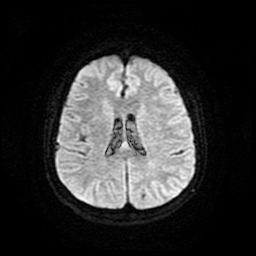 Cerebral metastases - melanoma (Radiopaedia 80972-94522 Axial DWI 19).jpg