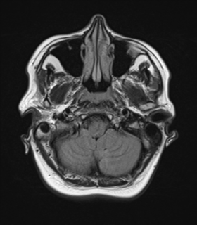 File:Cerebral metastases mimicking abscesses (Radiopaedia 45841-50131 Axial FLAIR 5).png