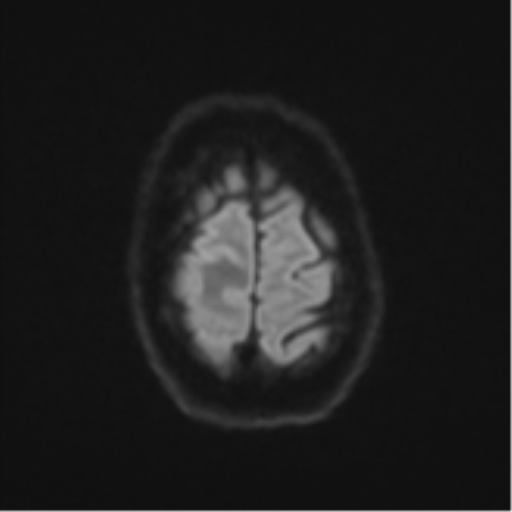 Cerebral metastasis - colorectal adenocarcinoma (Radiopaedia 50394-55765 Axial DWI 53).png