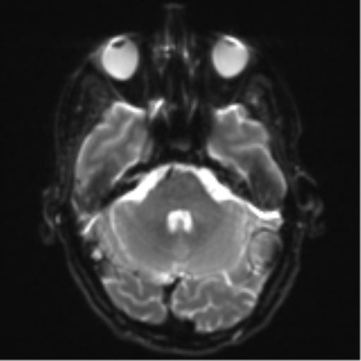Cerebral metastasis - melanoma (Radiopaedia 54718-60954 Axial DWI 9).png