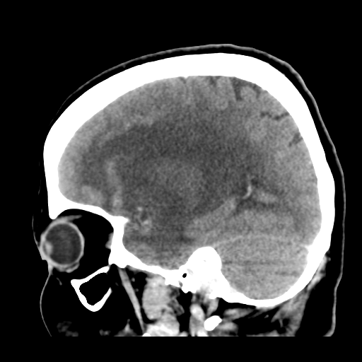 File:Cerebral metastasis to basal ganglia (Radiopaedia 81568-95412 Sagittal C+ delayed 19).png