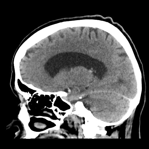 File:Cerebral metastasis to basal ganglia (Radiopaedia 81568-95412 Sagittal C+ delayed 35).png