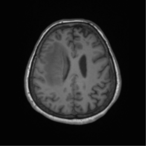 Cerebral metastasis to basal ganglia (Radiopaedia 81568-95413 Axial T1 52).png