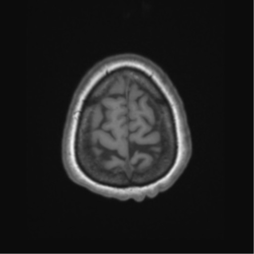 File:Cerebral metastasis to basal ganglia (Radiopaedia 81568-95413 Axial T1 67).png