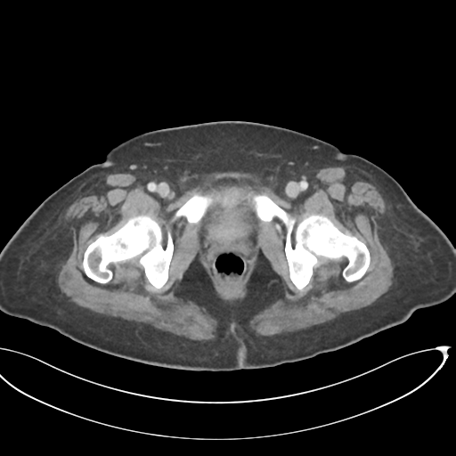 File:Cerebral metastasis to basal ganglia (Radiopaedia 81568-95414 E 76).png