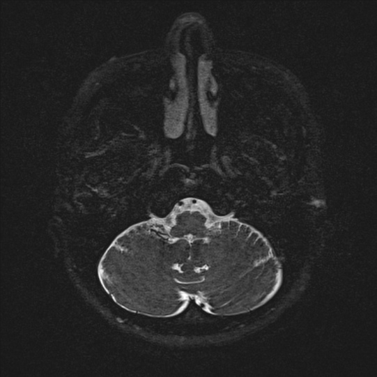 Cerebral ring enhancing lesions - cerebral metastases (Radiopaedia 44922-48817 F 9).jpg