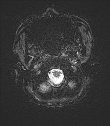 File:Cerebral toxoplasmosis (Radiopaedia 43956-47461 Axial SWI 1).jpg