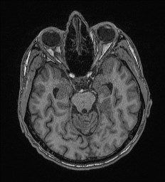File:Cerebral toxoplasmosis (Radiopaedia 43956-47461 Axial T1 27).jpg