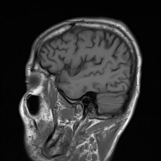 File:Cerebral toxoplasmosis (Radiopaedia 43956-47461 Sagittal T1 4).jpg