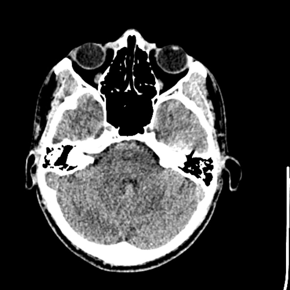 Cerebral toxoplasmosis (Radiopaedia 53993-60131 Axial non-contrast 23).jpg