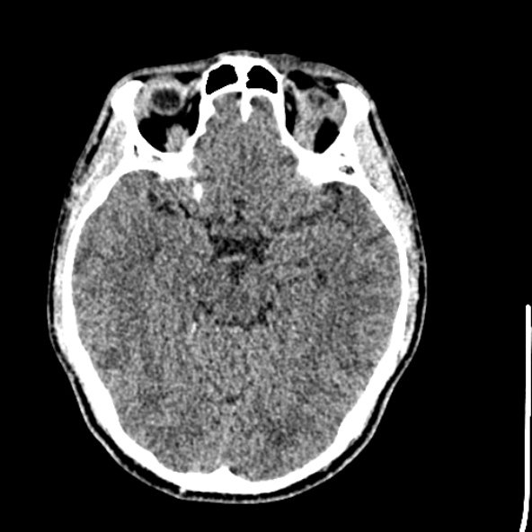 Cerebral toxoplasmosis (Radiopaedia 53993-60131 Axial non-contrast 32).jpg
