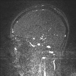 Cerebral tuberculosis with dural sinus invasion (Radiopaedia 60353-68090 Sagittal MRV 93).jpg