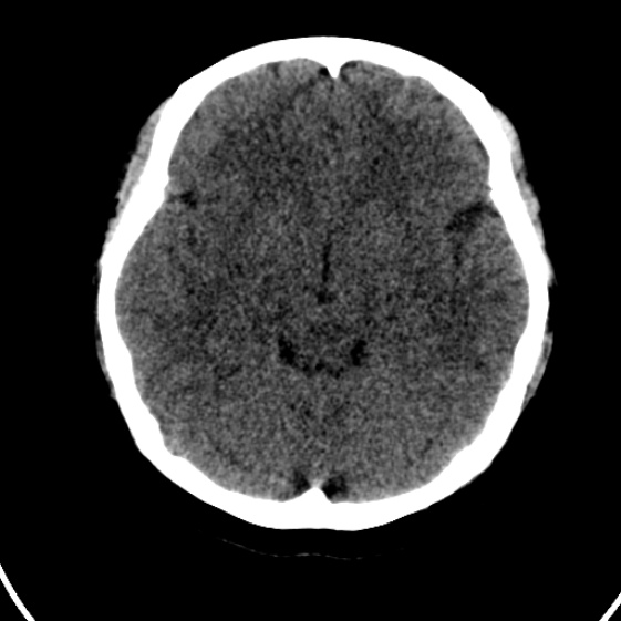 File:Cerebral venous hemorrhagic infarct from venous sinus thrombosis (Radiopaedia 55433-61879 Axial non-contrast 9).jpg