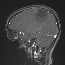 Cerebral venous infarction - hemorrhagic (Radiopaedia 81625-95505 Sagittal MRV 27).jpg