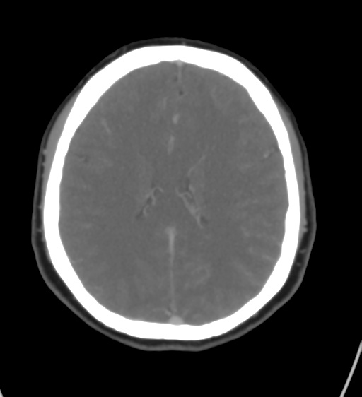 Cerebral venous infarction due to transverse sinus thrombosis (Radiopaedia 34688-36120 Axial CT venogram 32).png