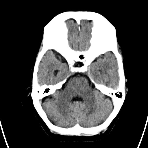 File:Cerebral venous infarction with hemorrhage (Radiopaedia 65343-74381 Axial non-contrast 6).jpg