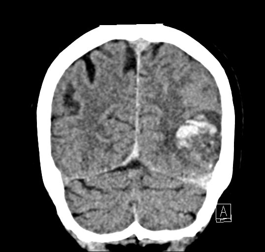 Cerebral venous infarction with hemorrhage (Radiopaedia 65343-74381 Coronal non-contrast 45).jpg
