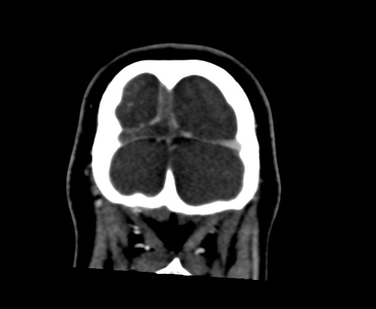 Cerebral venous sinus thrombosis (Radiopaedia 59224-66646 Coronal C+ delayed 72).jpg