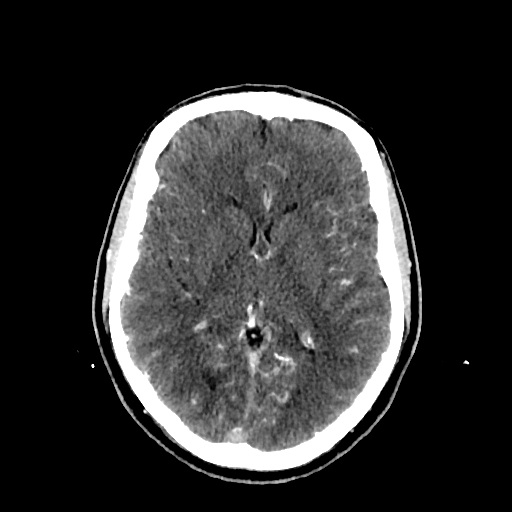 File:Cerebral venous thrombosis (CVT) (Radiopaedia 77524-89685 Axial with contrast 20).jpg