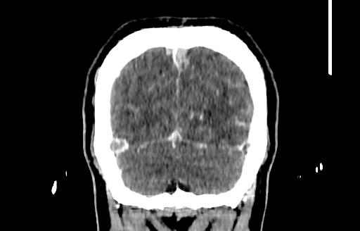 File:Cerebral venous thrombosis (CVT) (Radiopaedia 77524-89685 C 56).jpg