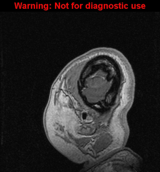 Cerebral venous thrombosis (Radiopaedia 37224-39208 Sagittal T1 C+ 143).jpg