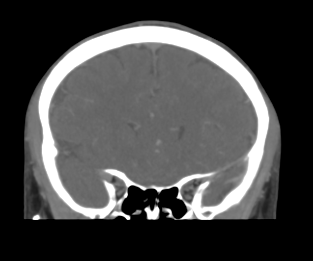 Cerebral venous thrombosis (Radiopaedia 38392-40467 Coronal CTA-Venogram 21).png