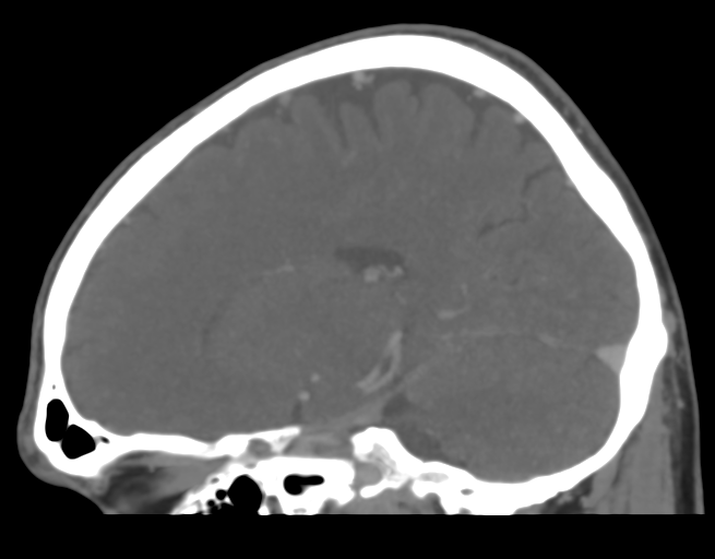 Cerebral venous thrombosis (Radiopaedia 38392-40467 D 21).png