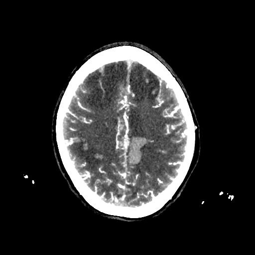 File:Cerebral venous thrombosis - hemorrhagic venous infarction (Radiopaedia 87318-103613 Axial 192).jpg