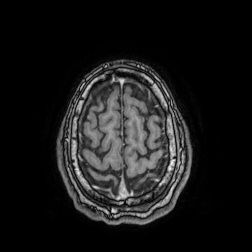 File:Cerebral venous thrombosis with secondary intracranial hypertension (Radiopaedia 89842-106957 Axial T1 C+ 146).jpg
