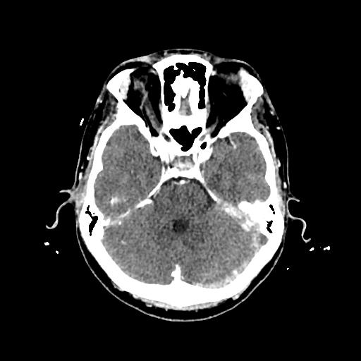 Cerebral venous thrombosis with venous hemorrhagic infarct (Radiopaedia 90354-107660 Axial with contrast 54).jpg