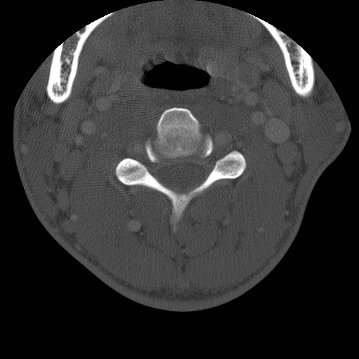 Cervical Pott disease (Radiopaedia 20374-20286 Axial bone window 60).jpg