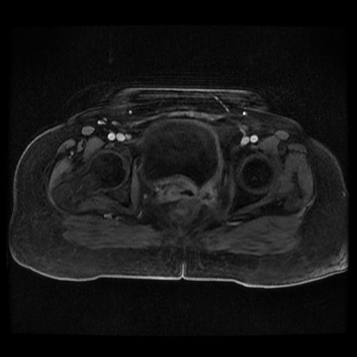 Cervical carcinoma (Radiopaedia 70924-81132 Axial T1 C+ fat sat 216).jpg