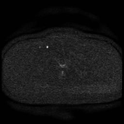 File:Cervical carcinoma (Radiopaedia 85405-101028 Axial DWI 62).jpg