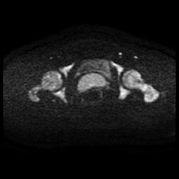 Cervical carcinoma (Radiopaedia 88010-104555 Axial DWI 66).jpg