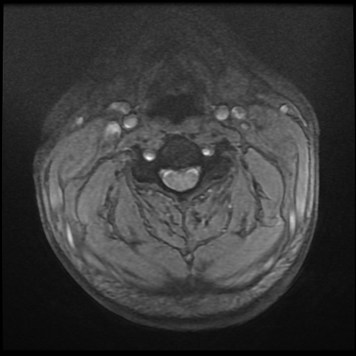 Cervical disc extrusion (Radiopaedia 59074-66364 F 13).jpg