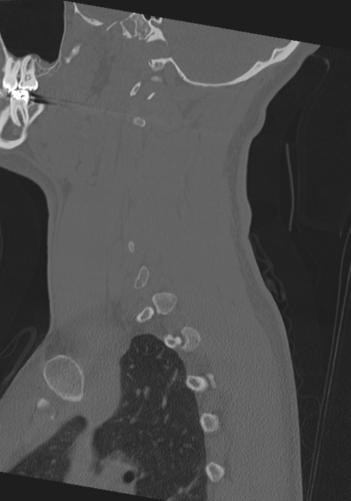 Cervical intercalary bone (Radiopaedia 35211-36748 Sagittal bone window 61).png